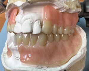 Acrylic Partial Denture 1