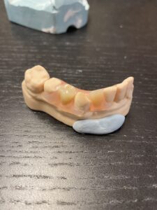 flexible partial denture 2